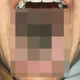 A new report in the New England Journal of Medicine describes a particularly severe case of black hairy tongue (pictured).